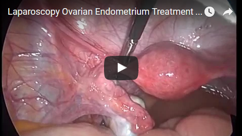Laparoscopy Ovarian Endometrium Treatment